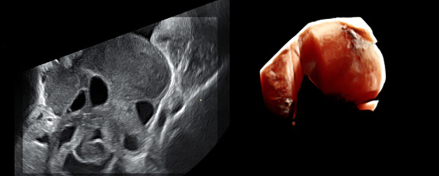 IMG_20150610_1_8 polipos Pólipos endometriales