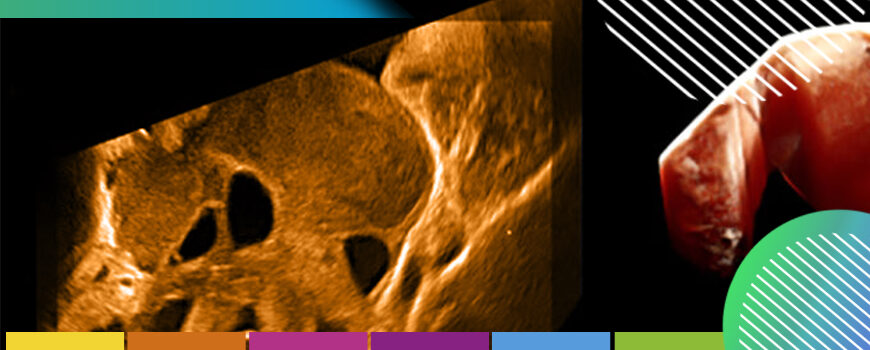 Pólipos uterinos o endometriales - Accuna