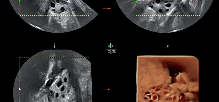 Drilling ovárico para activar la ovulación en caso de Síndrome de Ovario Poliquístico (SOP) Accuna